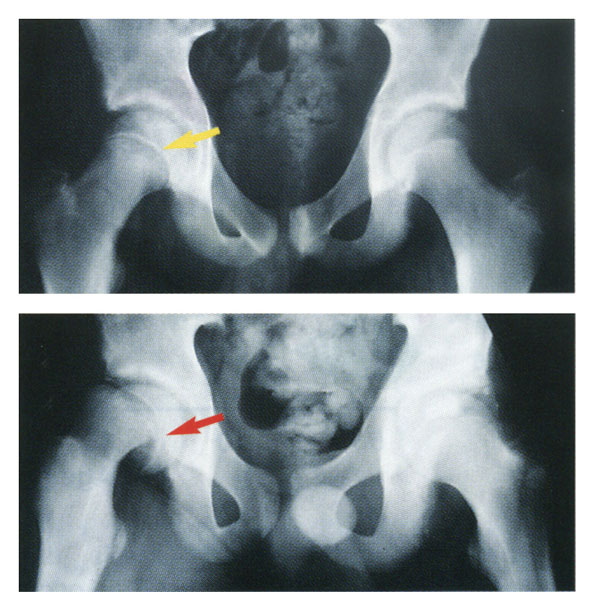 Normal hip joint (above) and slipped capital femoral epiphysis (below).