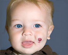 Hemangioma