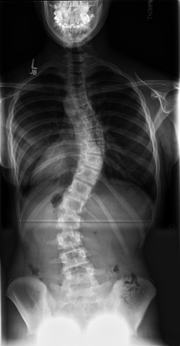 Scoliosis Xray