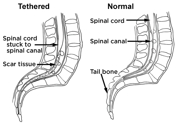 tethered spinal cord full