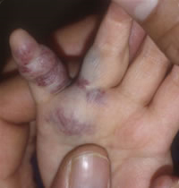 Venous malformation