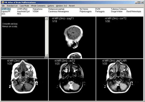 Brain Malformations Screen Shot 1