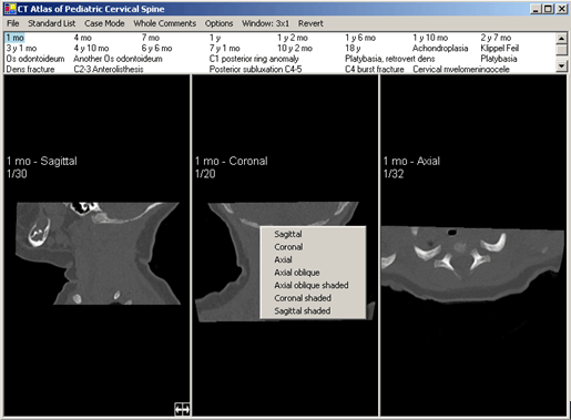 Cervical Spine Atlas Screen Shot 3