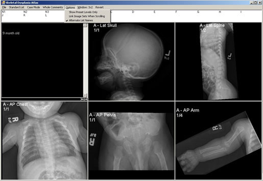 Achondroplasia in Case Mode in unknown format. By selecting 