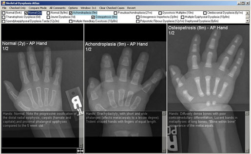 In this example, specific comparisons are being made between a normal hand and two different skeletal dysplasias. Semi-transparent comments are also enabled.