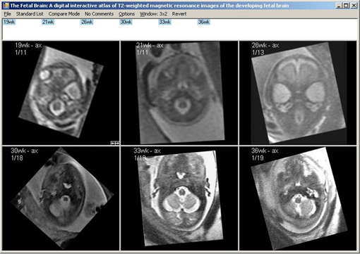 Fetal Brain Atlas Screen Shot 1