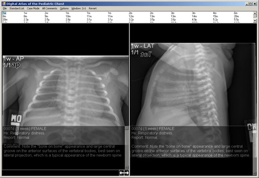 Pediatric Chest Atlas