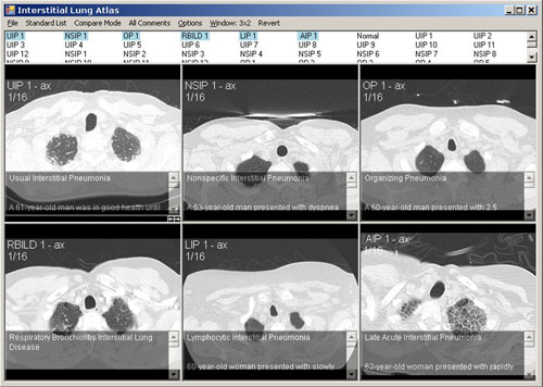 Interstitial Lung Atlas 2