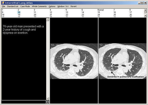 Interstitial Lung Atlas 3