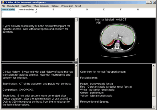 Retroperitoneal Spaces Atlas Screen Shot 1