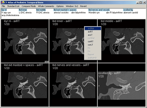 Temporal Bone Atlas Screen Shot 3