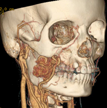 Vascular malformations